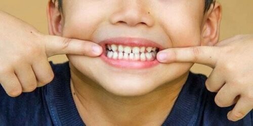 جلوگیری از پوسیدگی دندان با چند راهکار ساده