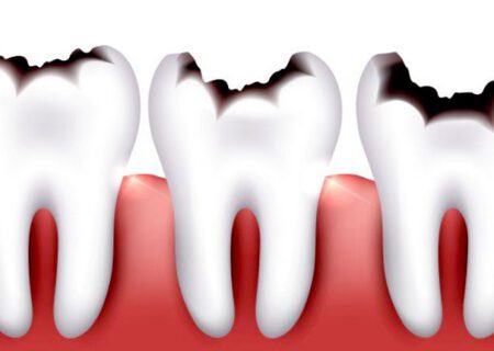 عوامل و راه‌های پیشگیری از پوسیدگی دندان‌ها